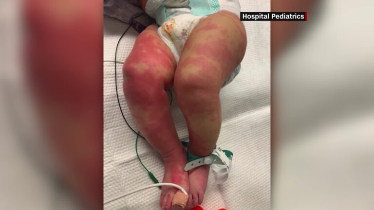 EE.UU.: Advierten que pueden venir más casos de extraña condición que afecta a los niños tras contagiarse de COVID-19