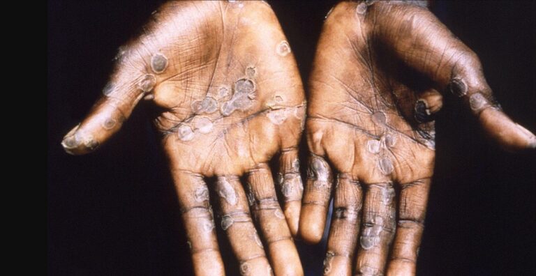 Costa Rica confirmó el primer caso de viruela del mono en un hombre estadounidense