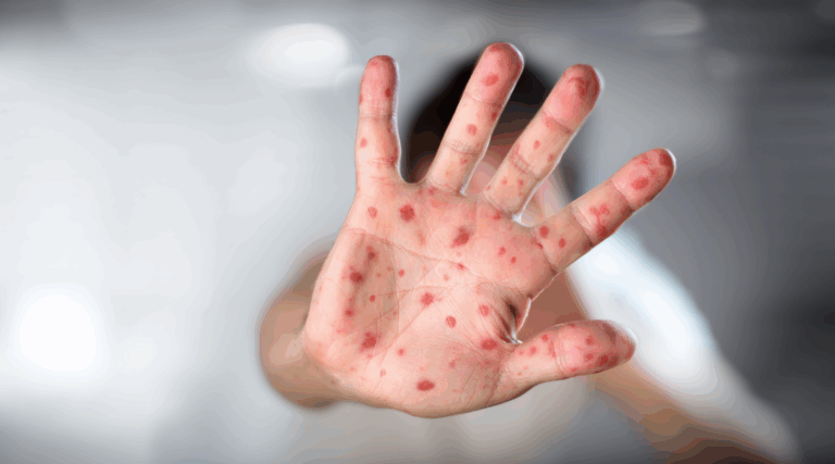 Suman 3: Costa Rica registró dos nuevos casos de viruela del mono