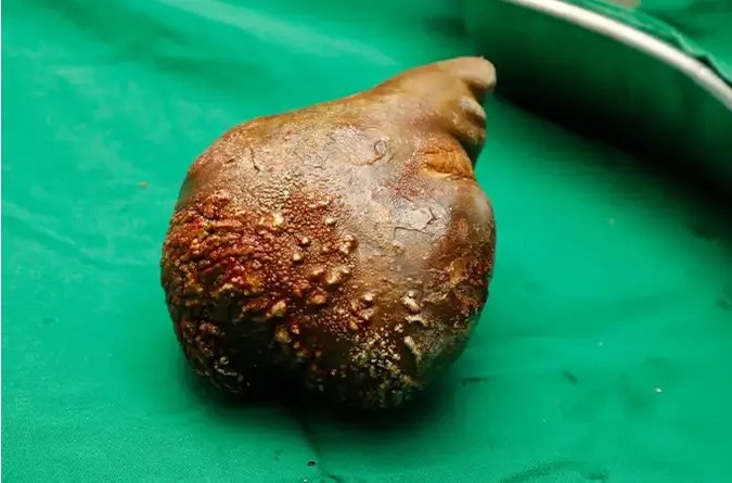 El cálculo renal más grande del mundo fue extirpado a un hombre de 62 años en Sri Lanka