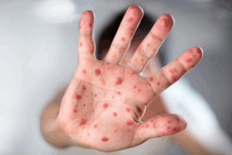 Seremi de Salud confirma caso de sarampión importado en la Región Metropolitana