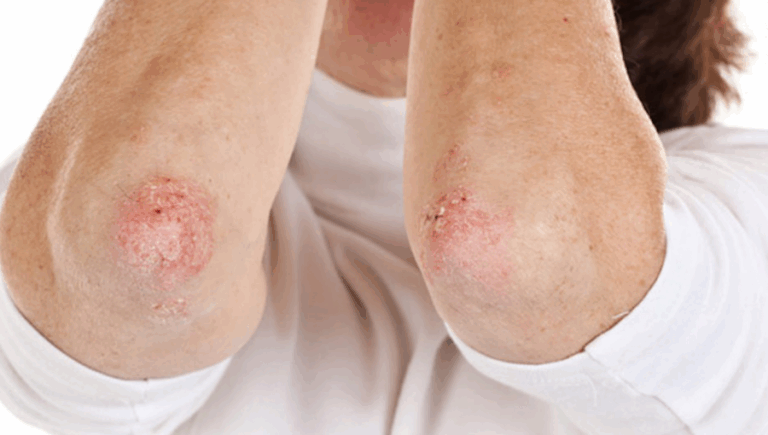 ¿Qué es la psoriasis?: Causas, tipos y tratamientos
