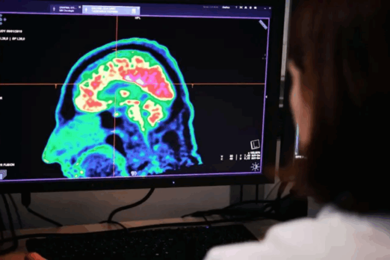 Estudio: Grasa abdominal estaría relacionada con primeras etapas del Alzheimer décadas antes de los primeros síntomas