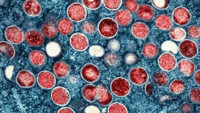 La OMS advierte de que es probable que haya más casos de viruela del mono en Europa en los próximos días y semanas