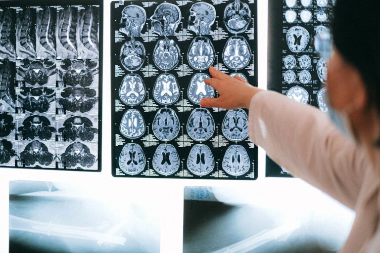 Neurólogo Juan Pablo Mansilla: ¿Cómo se puede prevenir un accidente cerebrovascular?