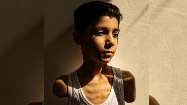 Foto de niño gazatíe que perdió ambos brazos tras ataque israelí ganó el World Press Photo del 2025
