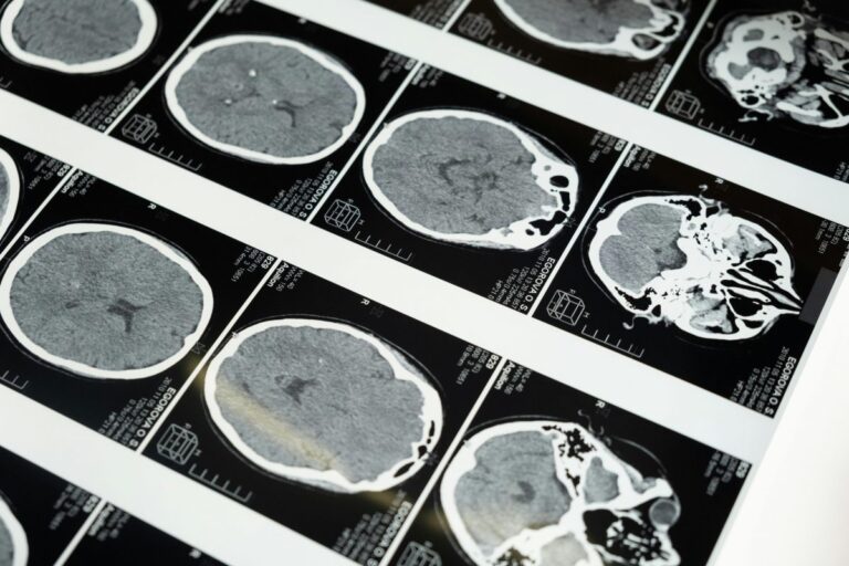 Neurólogo de Mayo Clinic explica: ¿Cómo identificar el Parkinson?