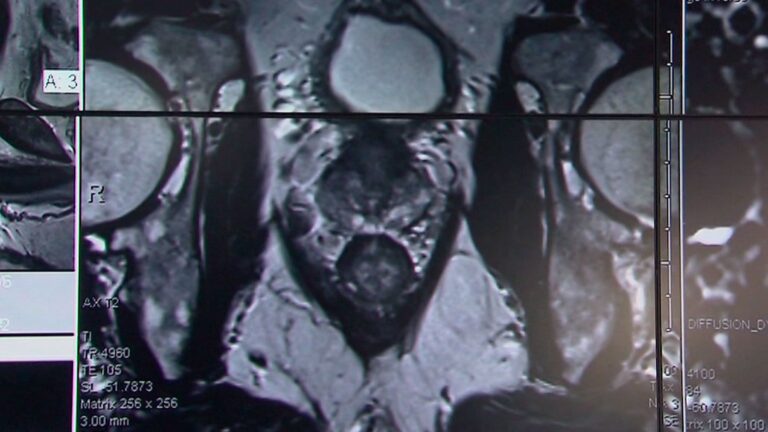 ¿Miedo al tacto rectal? Urólogo desmiente mitos sobre el examen de próstata y entrega recomendaciones