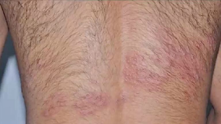 Herpes Zóster: El enemigo latente que despierta con el dolor y las bajas defensas