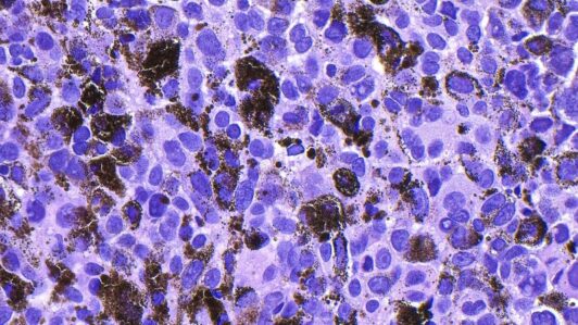 Prometedor avance: Vacuna de Moderna contra el cáncer de piel supera prueba de fase avanzada