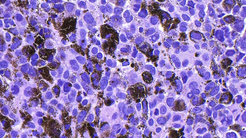 Prometedor avance: Vacuna de Moderna contra el cáncer de piel supera prueba de fase avanzada