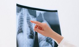 Cáncer de pulmón en Chile: ¿Cómo se diagnostica y cuáles son sus síntomas?