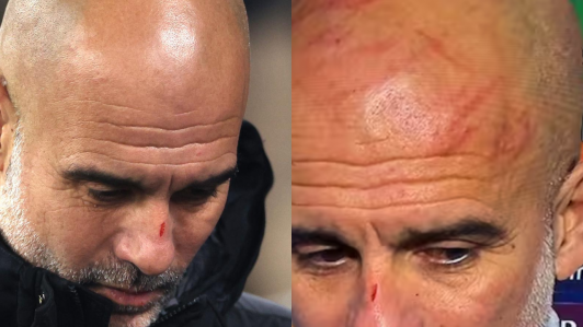 Guardiola aclara sus heridas tras el amargo empate ante el Feyenoord: "No quería quitar importancia a las autolesiones"