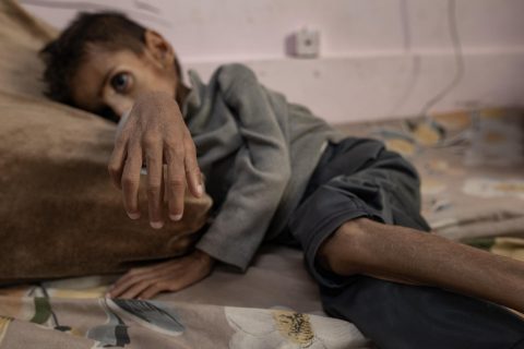 5.100 niños con desnutrición aguda en un mes: el desgarrador balance de la ONU en Gaza tras bloqueo israelí