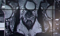 ¿Miedo al tacto rectal? Urólogo desmiente mitos sobre el examen de próstata y entrega recomendaciones