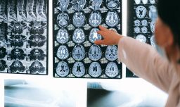 ¿Te preocupa el Alzheimer? Estudio revela qué habito podría reducir el riesgo de padecerlo