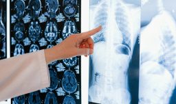 Estudio alerta alza del cáncer en menores de 50 años: ¿A qué factores podría deberse?