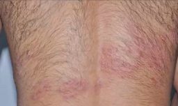 Cómo enfrentar el herpes zóster, una enfermedad silenciosa que puede dejar secuelas dolorosas
