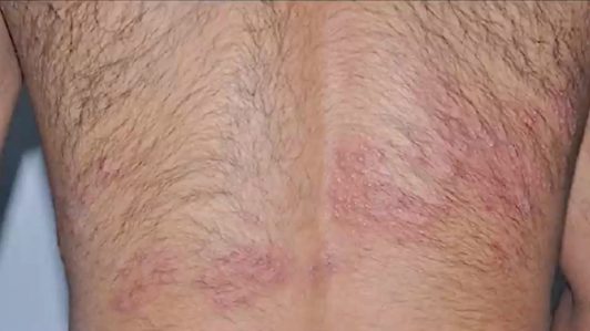 Cómo enfrentar el herpes zóster, una enfermedad silenciosa que puede dejar secuelas dolorosas