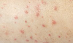 Cómo identificar los síntomas del sarampión y qué hacer si los presentas