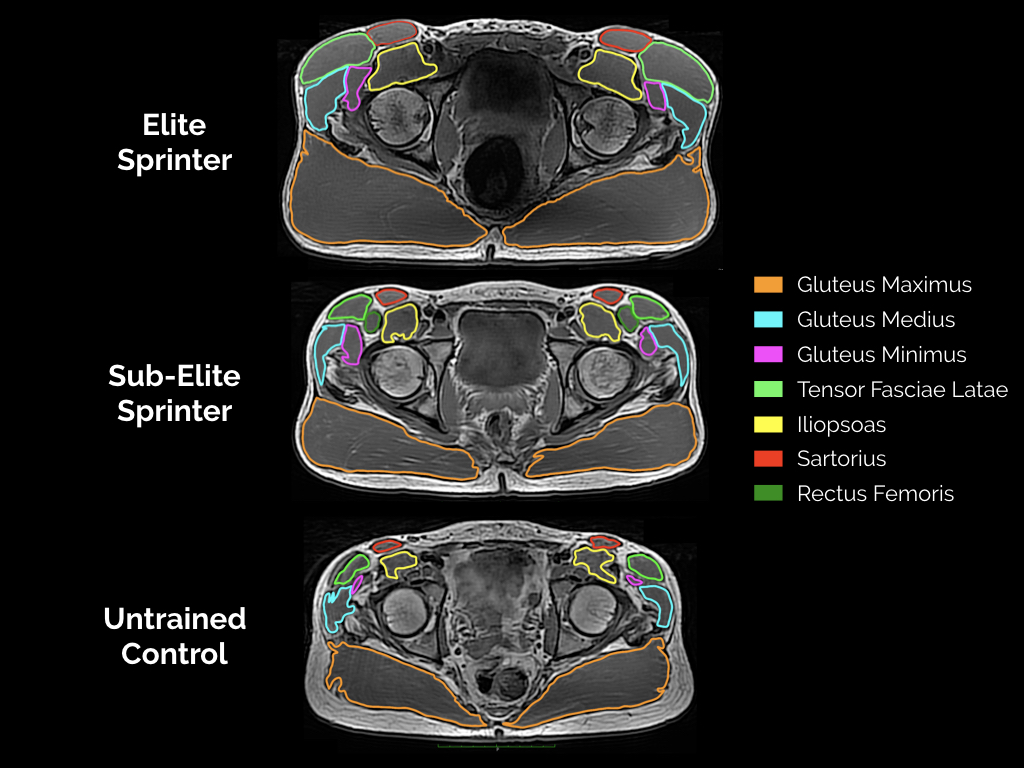 Pelvis Muscles Mri Anatomy Mri Hip Jiont Anatomy Drah - vrogue.co