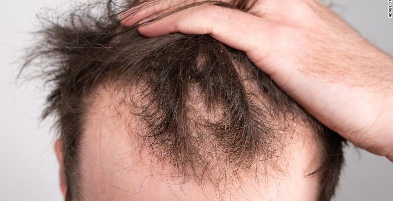 Estudio examina qué tratamiento para la calvicie masculina funciona